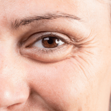 Online Wrinkle Treatment Online Wrinkle Treatment